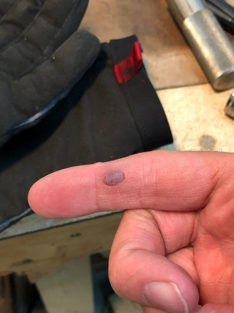 It’s not a project without an injury